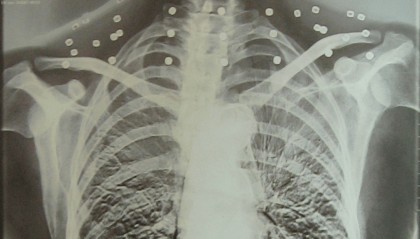 “老先生，您把项链取下来再做CT”